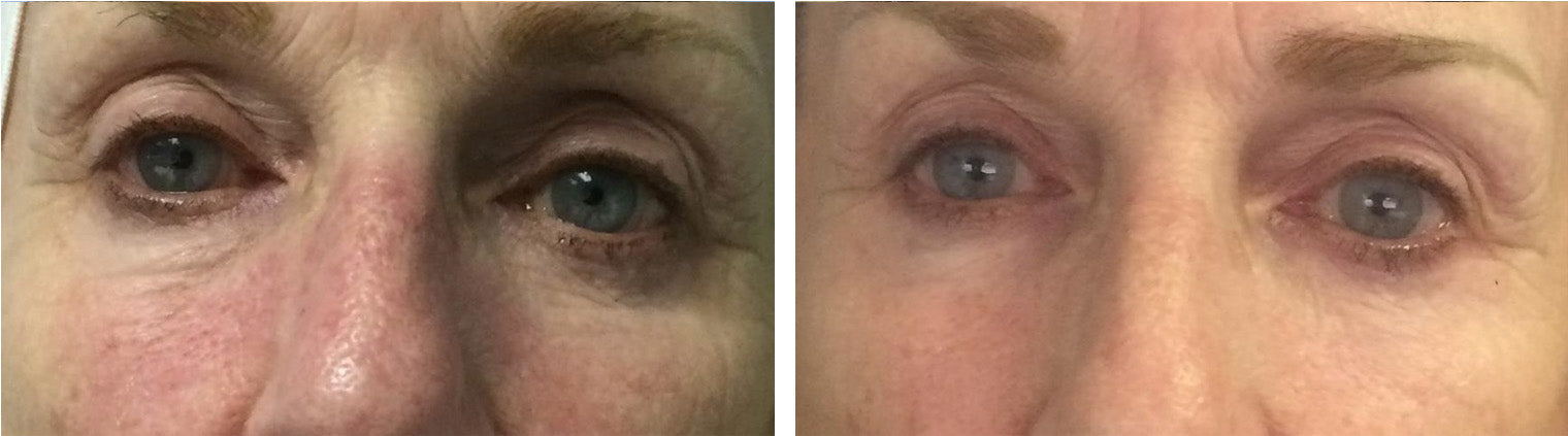 Anti-Aging Eyelid Rejuvination Before/After